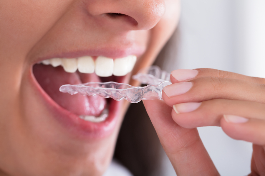 close portrait of a woman holding clear aligners