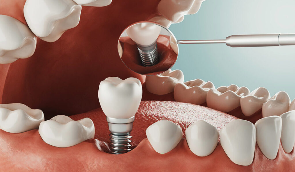 Closeup of a dental implant filling up a missing tooth space in 3D illustration