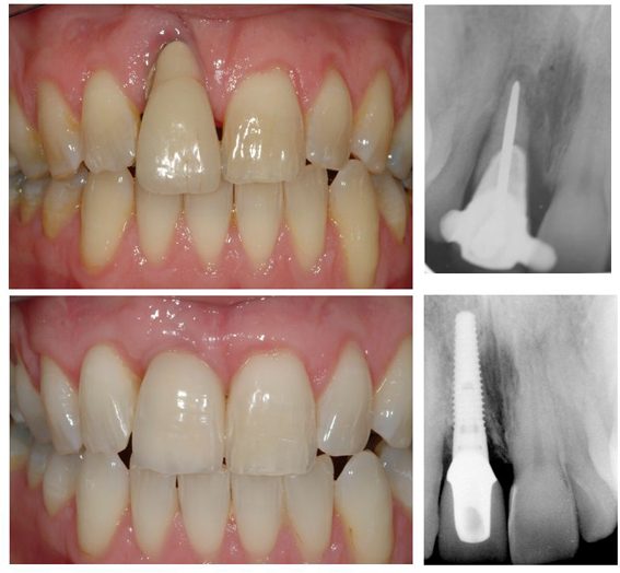 before and after image of a patient's mouth with x-ray indicating a dental implant