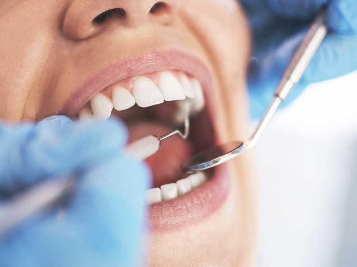 Close up of a woman mouth having a dental filling procedure done