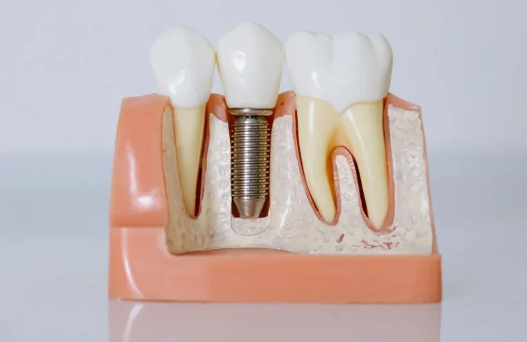 dental bridges